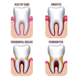 Image displaying gum disease of a Calgary dental patient