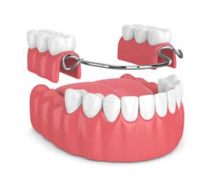 Removable partial denture dental clinic in Calgary SW