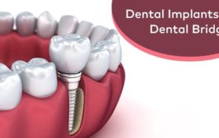 Dental Implants Vs Dental Bridges