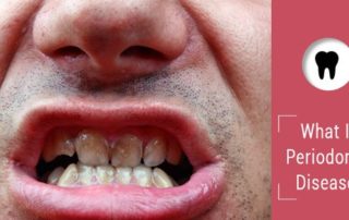 Periodontal Disease Affected Teeth