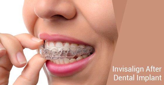 Traditional Braces Vs Invisalign, Airdrie Dentist