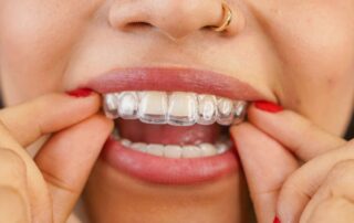 can invisalign be used after a dental implant