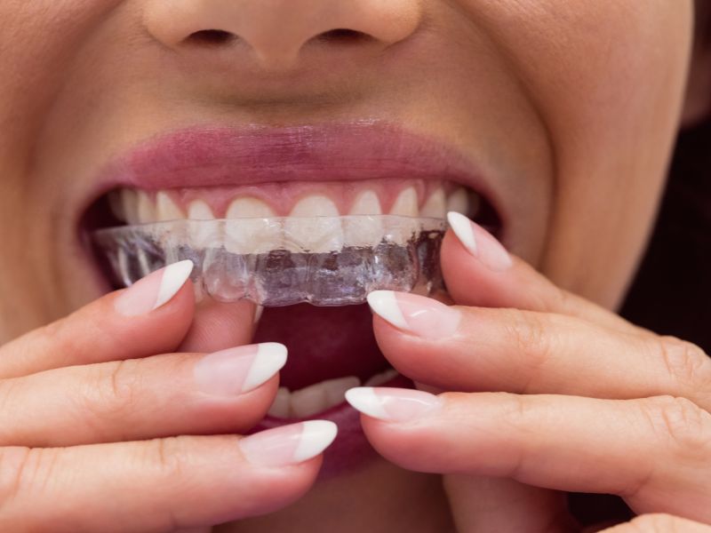 do i need to extract teeth If I’m considering invisalign