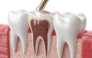 root canals vs cavities