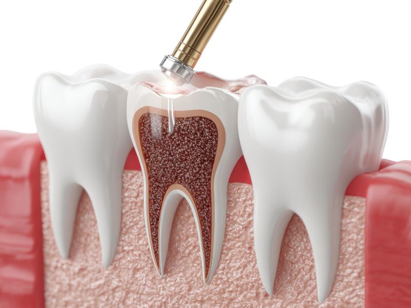 root canals vs cavities