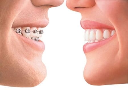 Braces vs no braces for Calgary Dental Patients