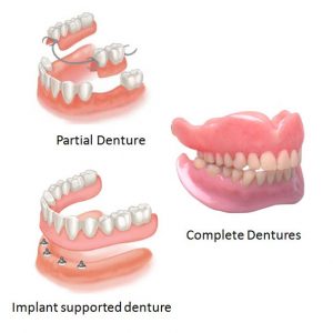 partial dentures, complete dentures, implant supported dentures dental clinic in Calgary SW