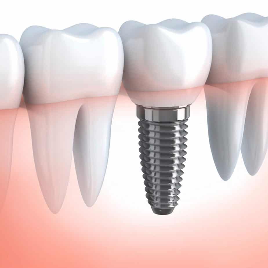 An Image for Dental Implants in Calgary