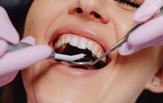 dental bonding vs. crowns