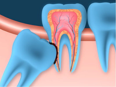 wisdom tooth removal in Calgary SW