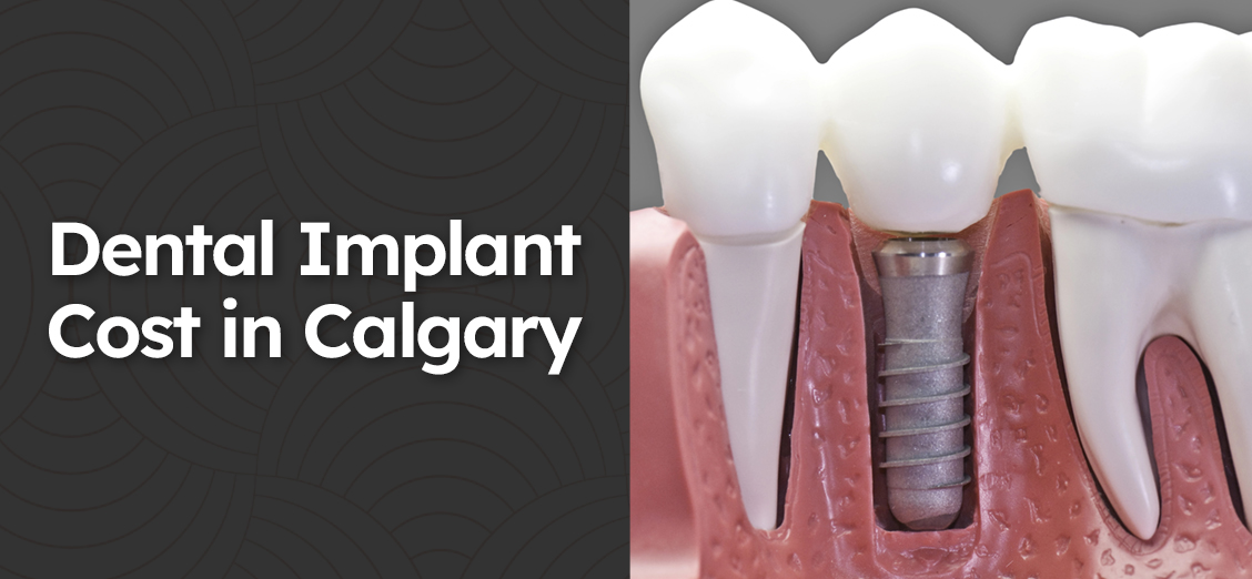 Dental Implant Cost in Calgary