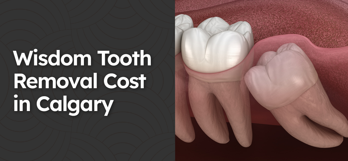 Wisdom Tooth Removal Cost in Calgary