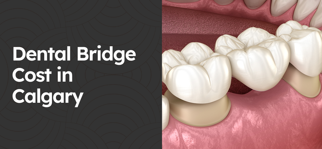 Dental Bridge Cost in Calgary
