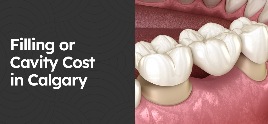 Dental Filling or Cavity Cost in Calgary Sierra Dental