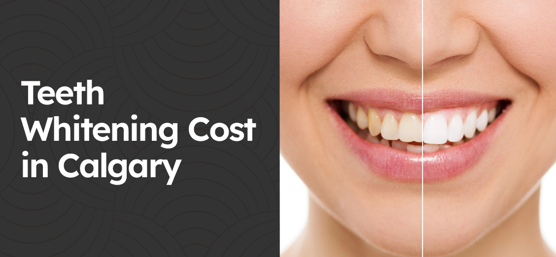 Teeth Whitening Cost in Calgary