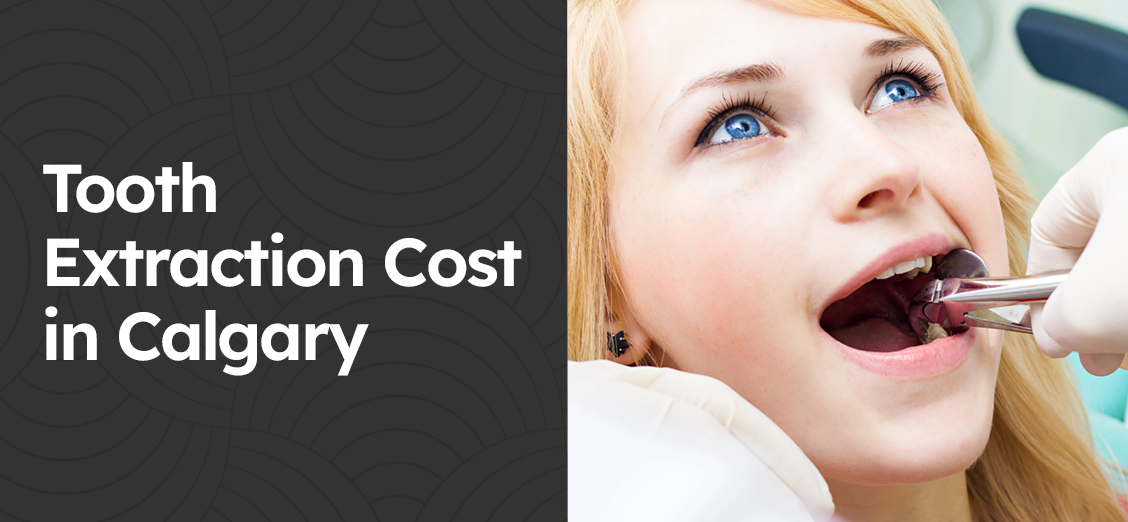Tooth Extraction Cost in Calgary