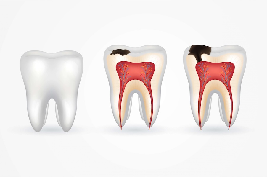 Periodontitis bone loss in teeth