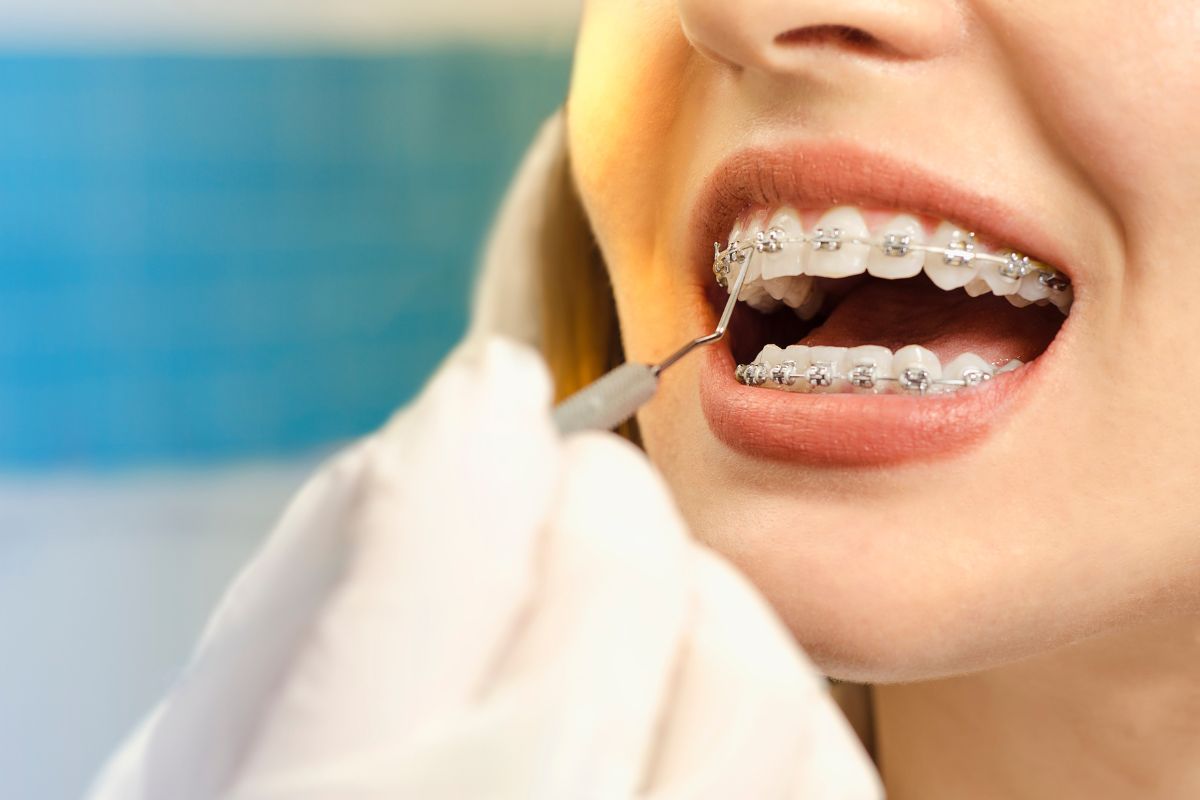 Self ligating braces.