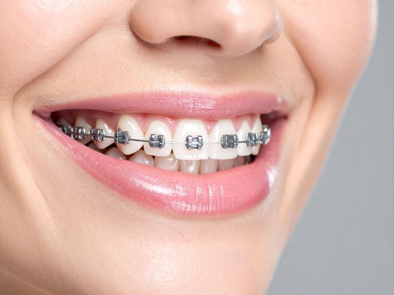 Close-up of a smiling patient wearing self-ligating braces.