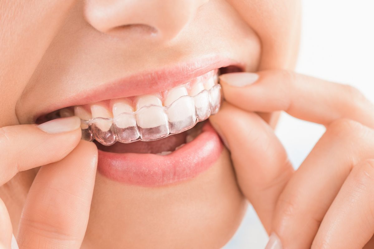 Invisalign braces.