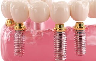 All-on-Four Dental Implants: A Complete Guide