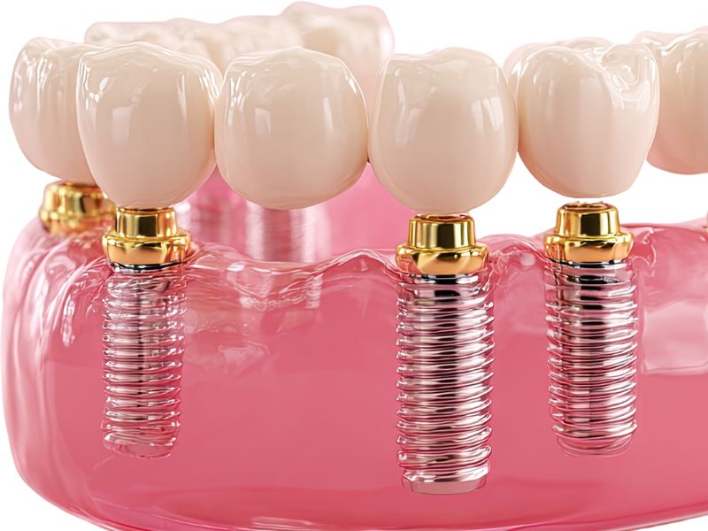 All-on-Four Dental Implants: A Complete Guide