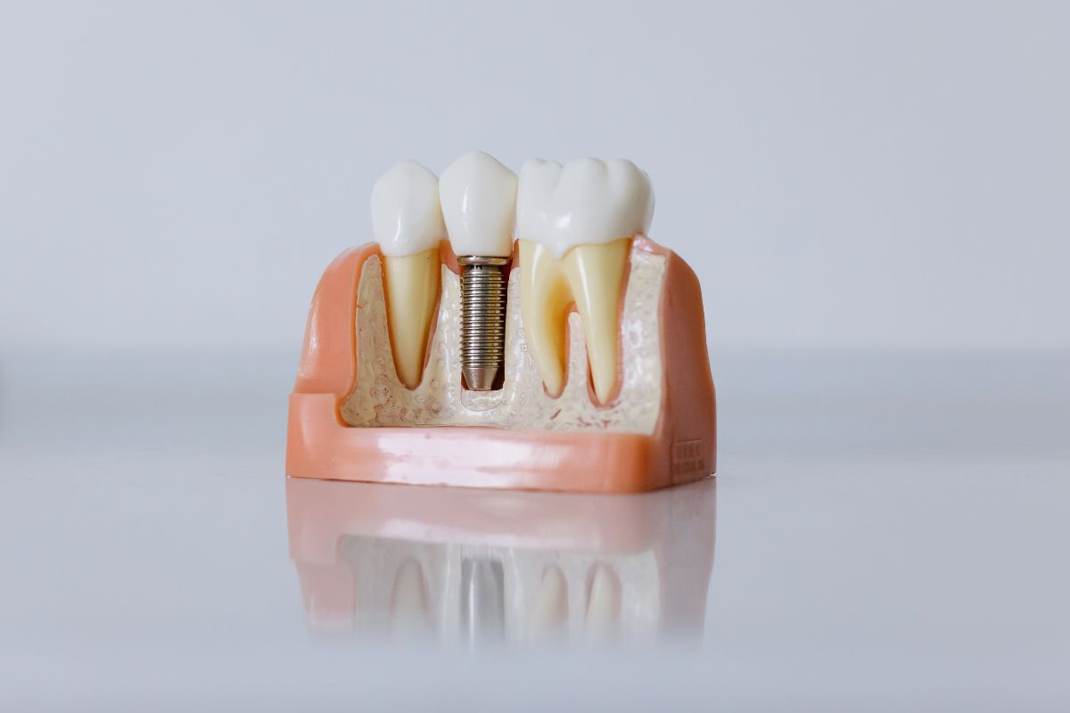 What is an All-on-4 Implant