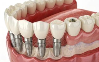 all-on-four dental implants