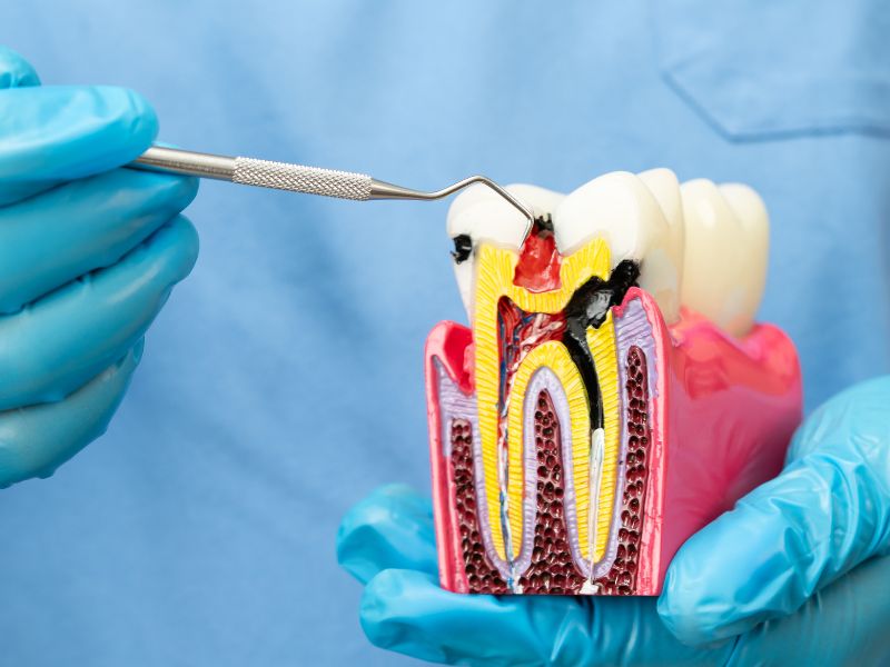 root canal