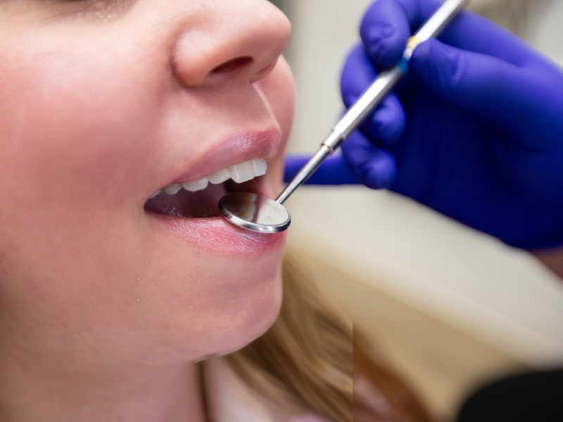 Cosmetic-Dental-Bonding