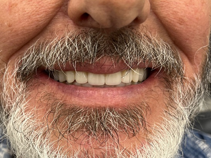 Denture-Clinic-in-Calgary